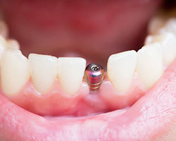 single tooth implant