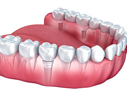 multiple tooth implant