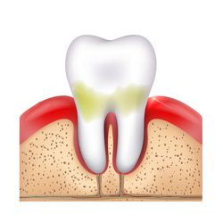 early stage periodontitis