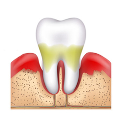 middle stage periodontitis