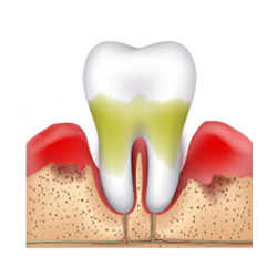 advanced stage periodontitis