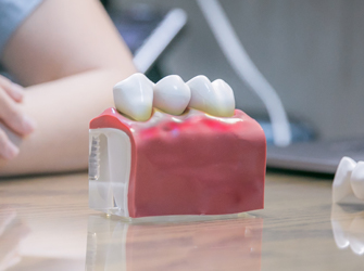 how periodontitis look like